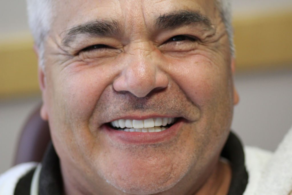 paciente-implantes-dentales-tijuana