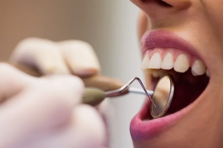 Limpieza dental en tijuana1