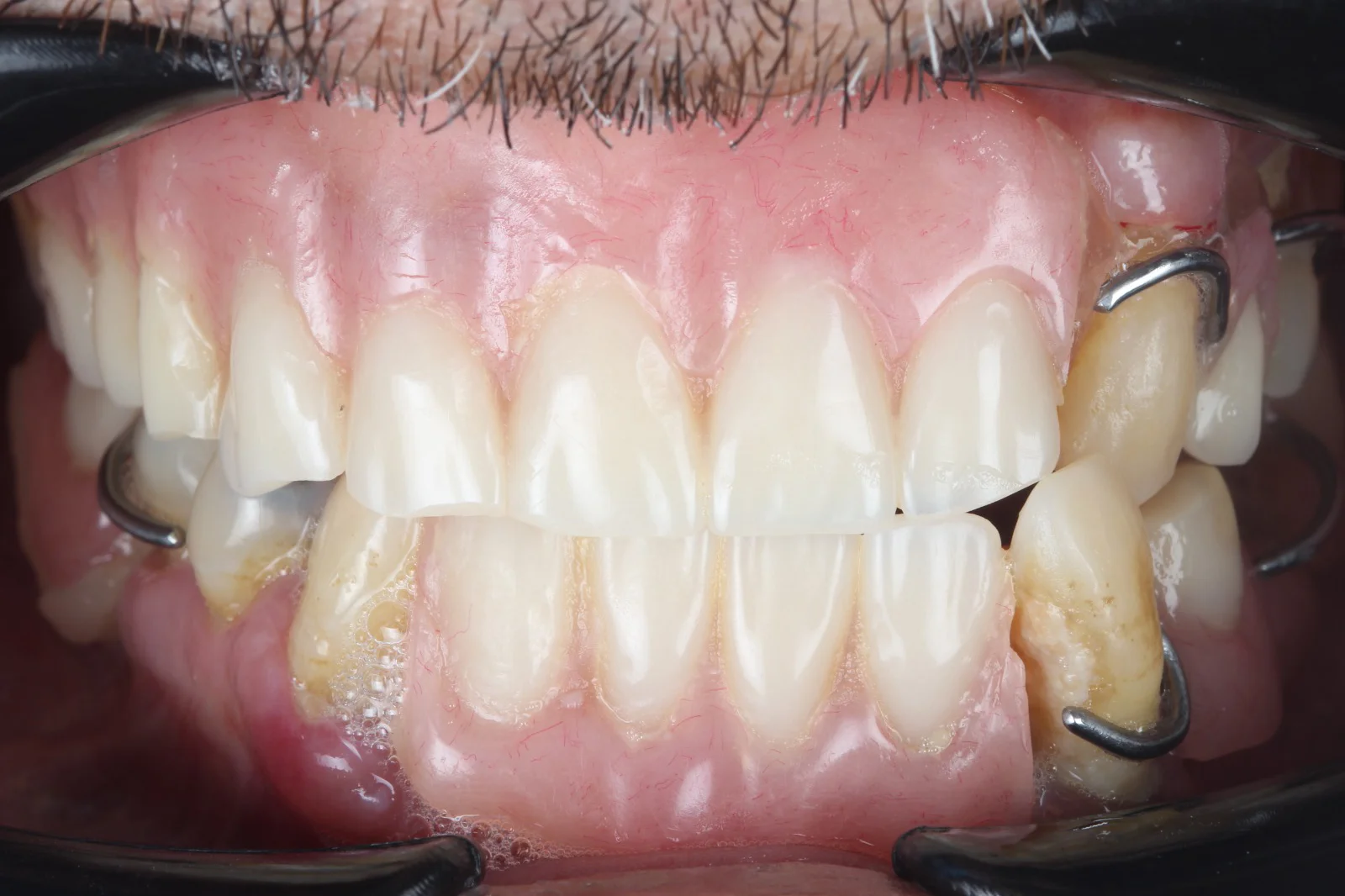 implantes dentales antes