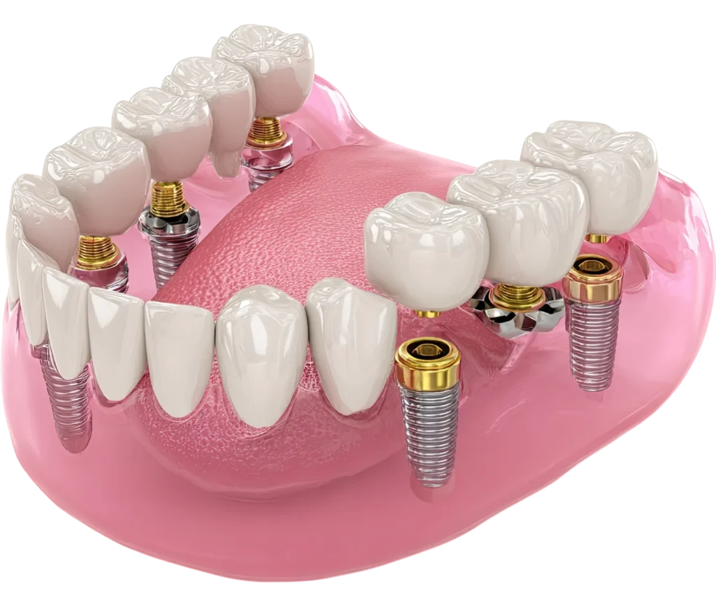 implantes dentales en tijuana 2