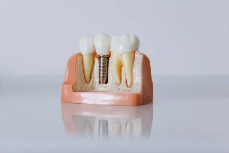 implantes dentales en tijuana 4