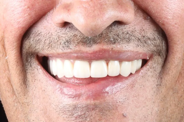 implantes dentales en tijuana